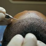 best hair transplant in Lahore