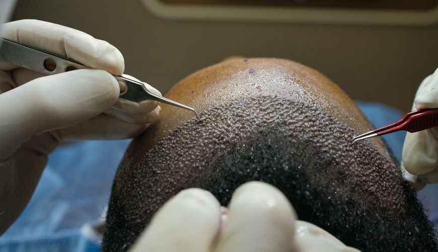 best hair transplant in Lahore