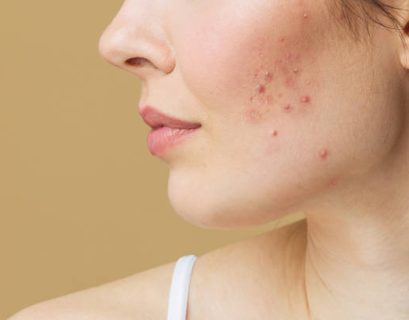 Acne treatment - Midas Wellness Hub