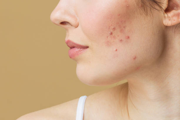 Acne treatment - Midas Wellness Hub