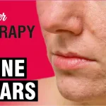 Laser Skin Treatment for Scars at Sakhiya Skin Clinic