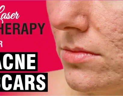 Laser Skin Treatment for Scars at Sakhiya Skin Clinic