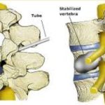 Vertebroplasty and Kyphoplasty