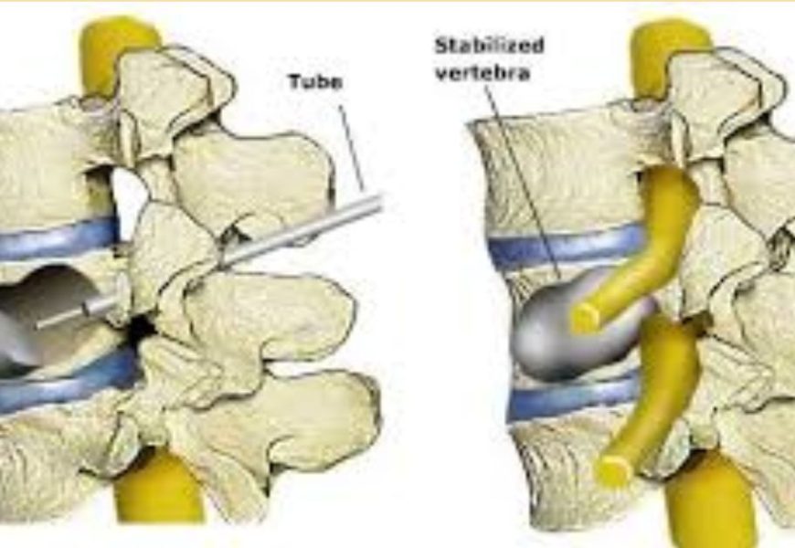 Vertebroplasty and Kyphoplasty