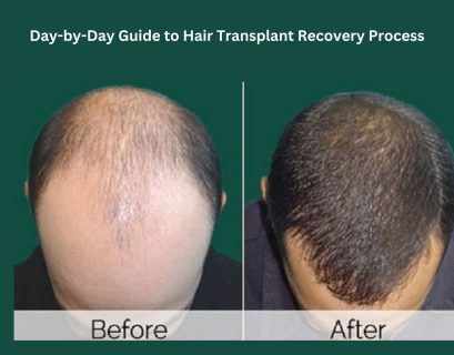 Hair Transplant Recovery Day By Day