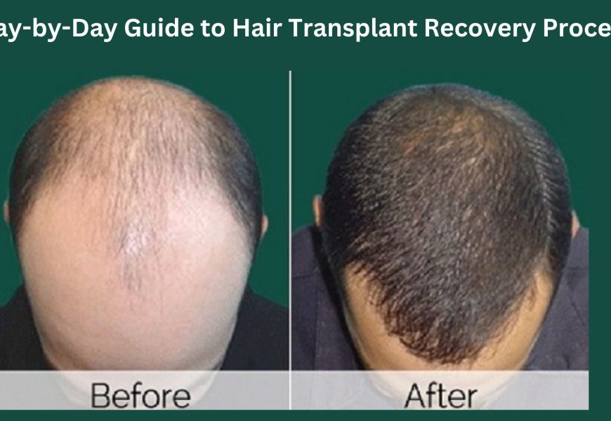 Hair Transplant Recovery Day By Day